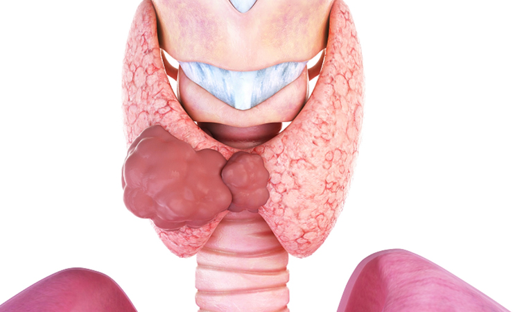 Ilustração sobre nódulos de tireoide