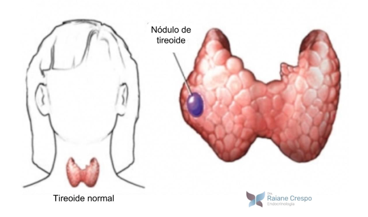 Ilustração de nódulo de tireoide