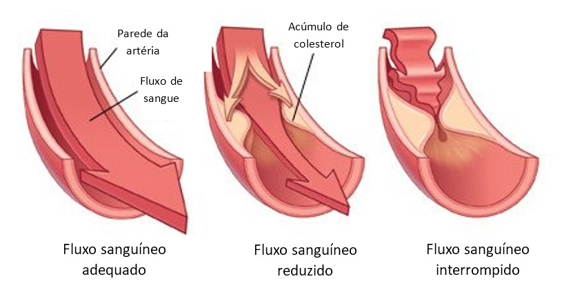 Colesterol Elevado | Dra. Raiane Crespo