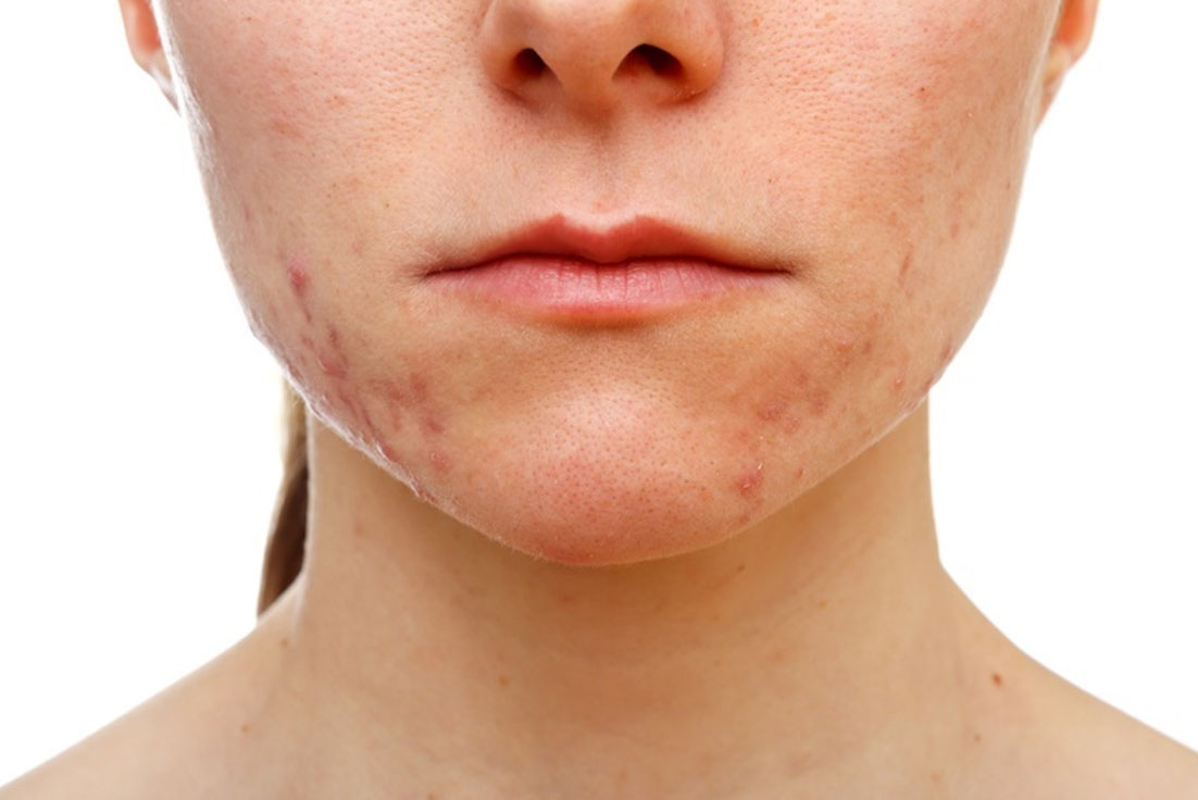 Acne Hormonal | Dra. Raiane Crespo