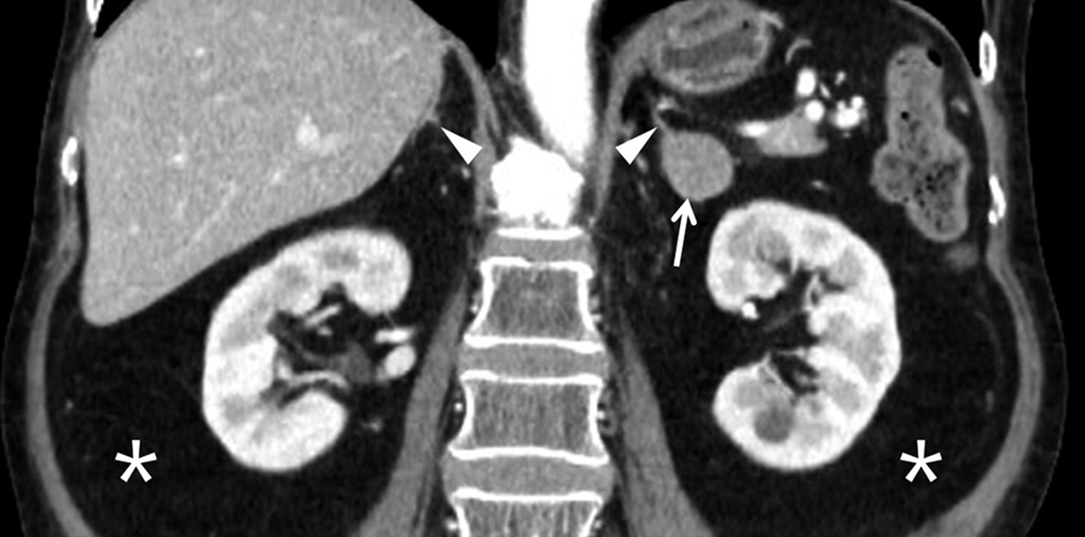 Nódulo adrenal | Dra. Raiane Crespo 