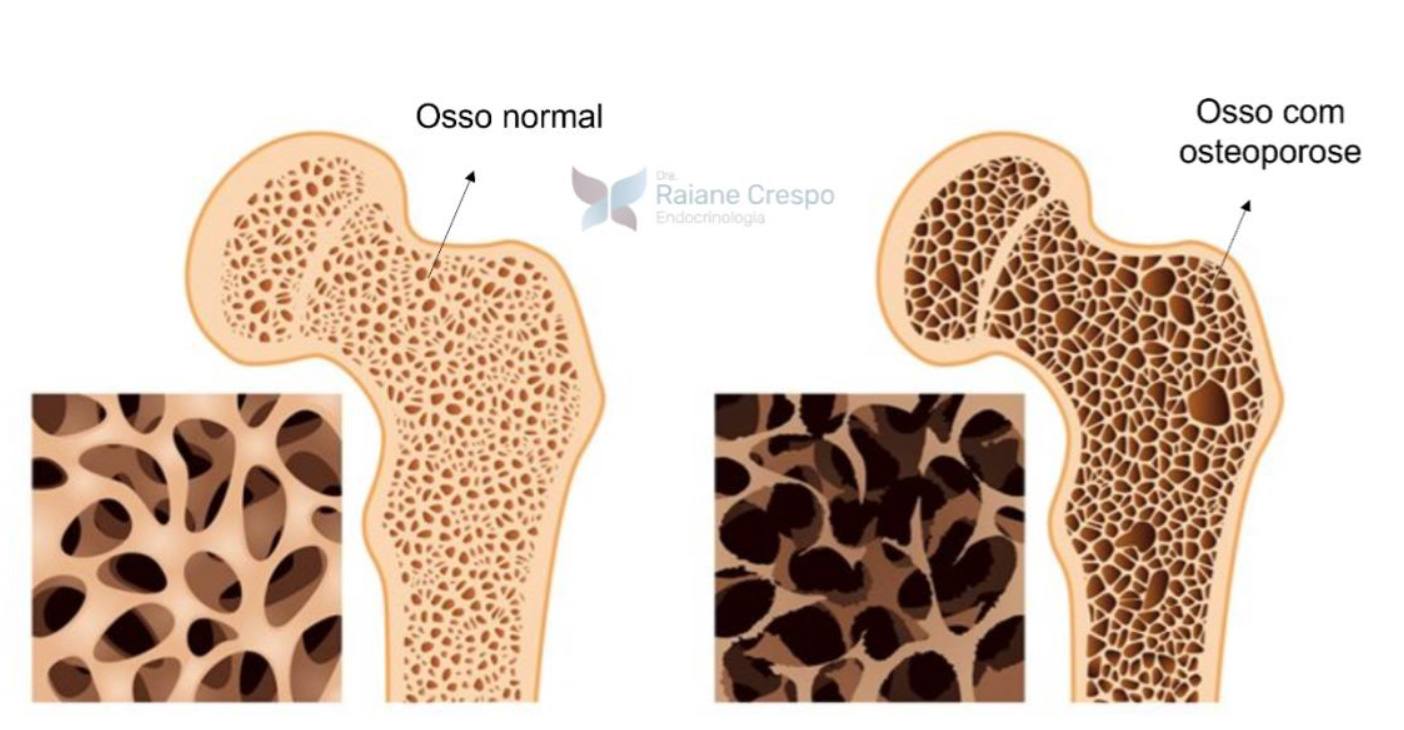 Osteopenia e osteoporose | Dra. Raiane Crespo