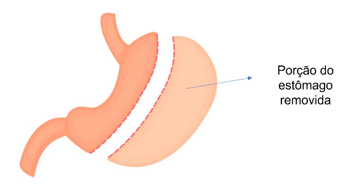 Cirurgia bariátrica | Dra. Raiane Crespo 