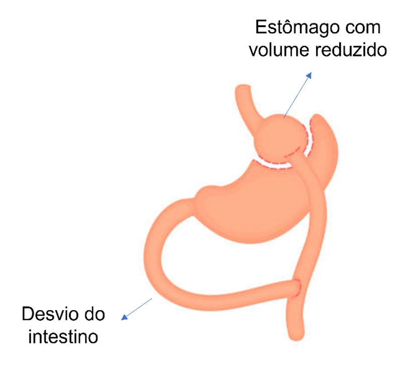 Cirurgia bariátrica | Dra. Raiane Crespo 